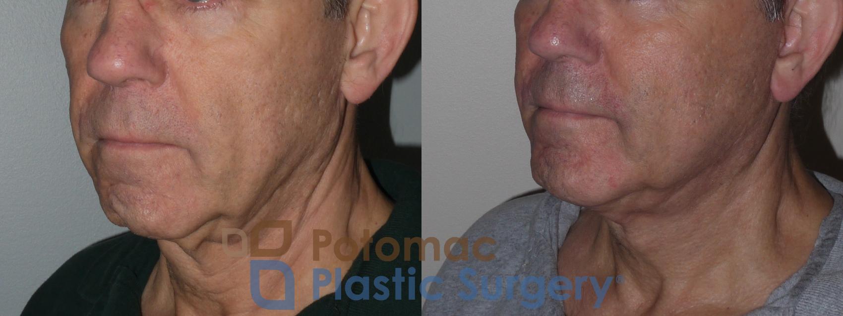 Before & After Chin Augmentation Case 258 Left Oblique View in Washington, DC