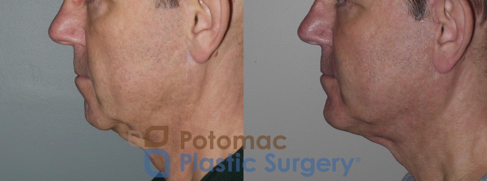Before & After Chin Augmentation Case 258 Left Side View in Washington, DC