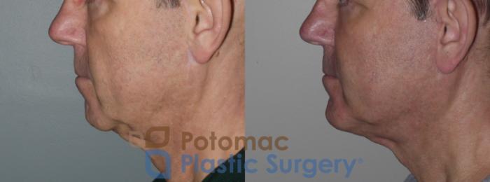 Before & After Chin Augmentation Case 258 Left Side View in Washington DC & Arlington , DC