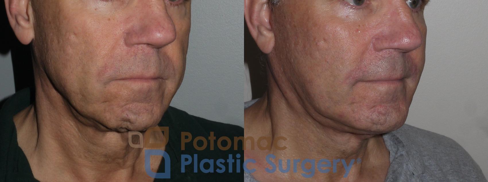 Before & After Chin Augmentation Case 258 Right Oblique View in Washington, DC