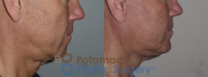 Before & After Chin Augmentation Case 258 Right Side View in Washington DC & Arlington , DC
