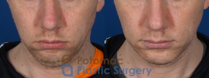 Before & After Chin Augmentation Case 272 Above View in Washington DC & Arlington , DC