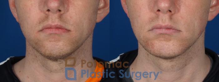 Before & After Chin Augmentation Case 272 Front View #1 View in Washington DC & Arlington , DC