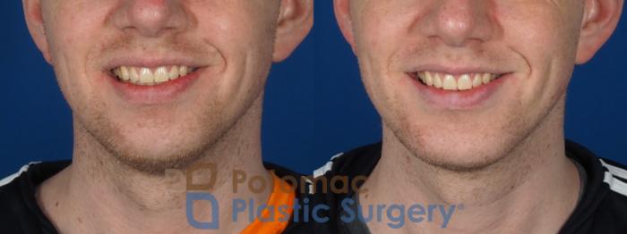 Before & After Chin Augmentation Case 272 Front View #2 View in Washington DC & Arlington , DC