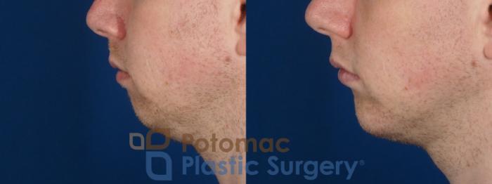Before & After Chin Augmentation Case 272 Left Side View in Washington DC & Arlington , DC
