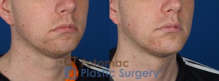 Before & After Chin Augmentation Case 272 Right Oblique View in Washington DC & Arlington , DC