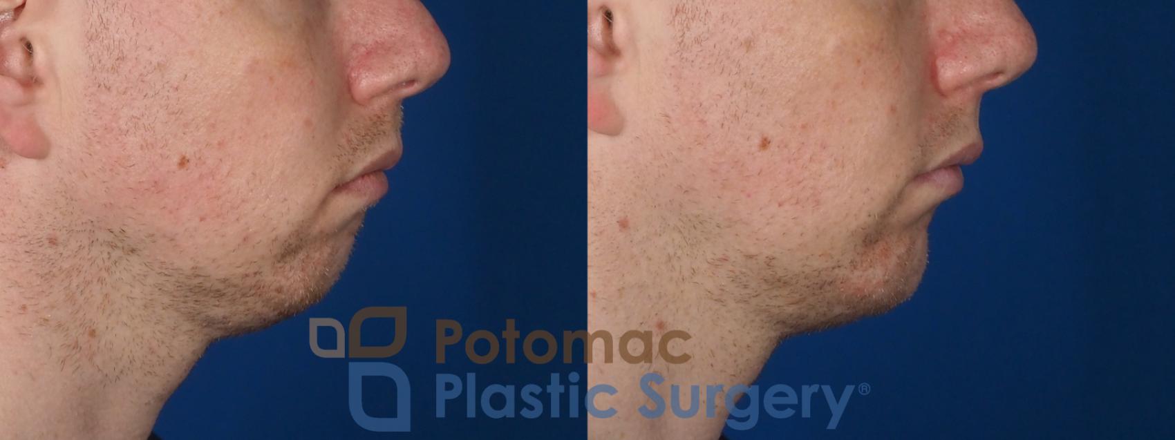 Before & After Chin Augmentation Case 272 Right Side View in Washington DC & Arlington , DC