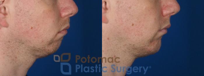 Before & After Chin Augmentation Case 272 Right Side View in Washington DC & Arlington , DC