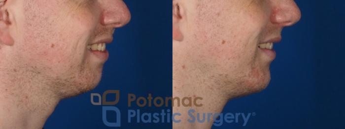 Before & After Chin Augmentation Case 272 Right Side View #2 View in Washington DC & Arlington , DC