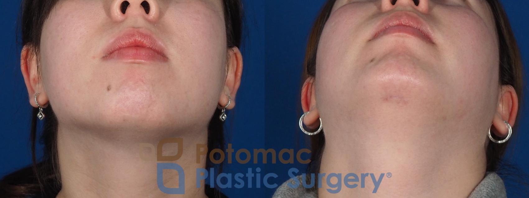 Before & After Chin Augmentation Case 280 Bottom View in Washington, DC