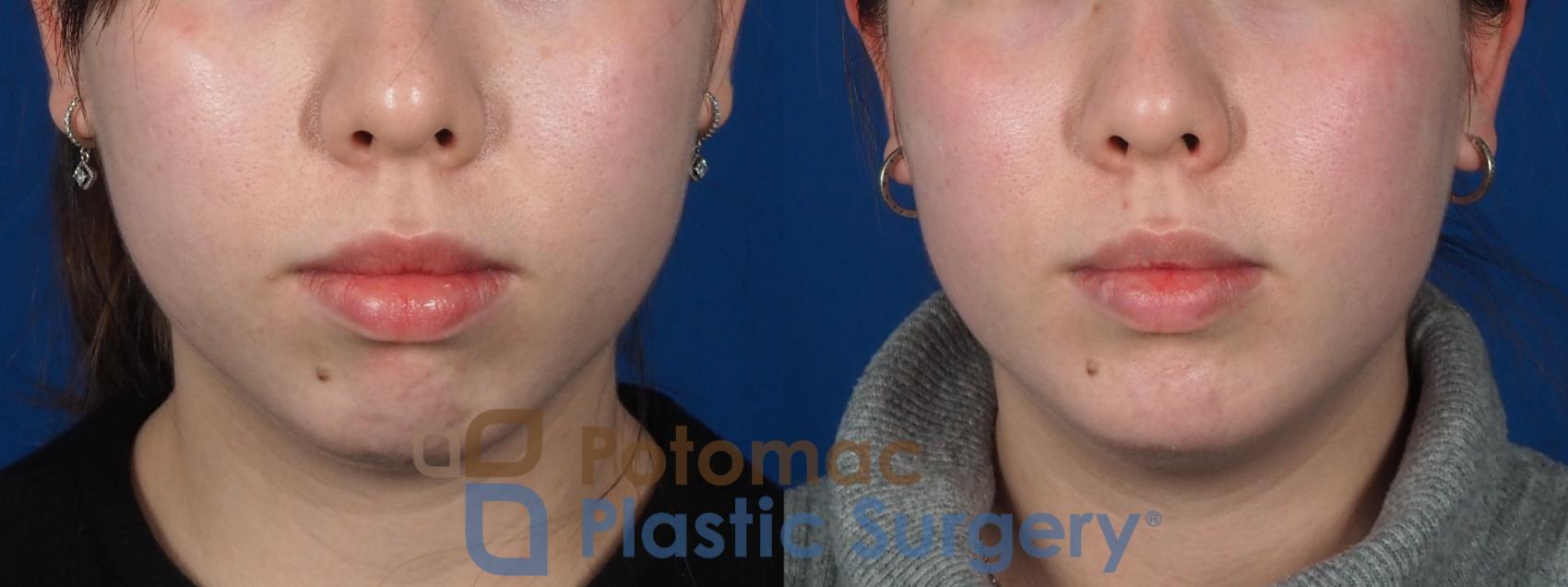 Before & After Chin Augmentation Case 280 Front View in Washington, DC