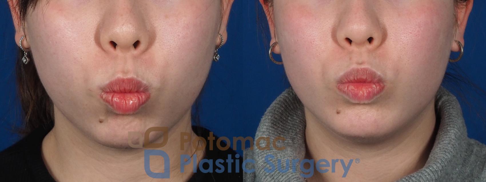 Before & After Chin Augmentation Case 280 Front - Pucker View in Washington, DC