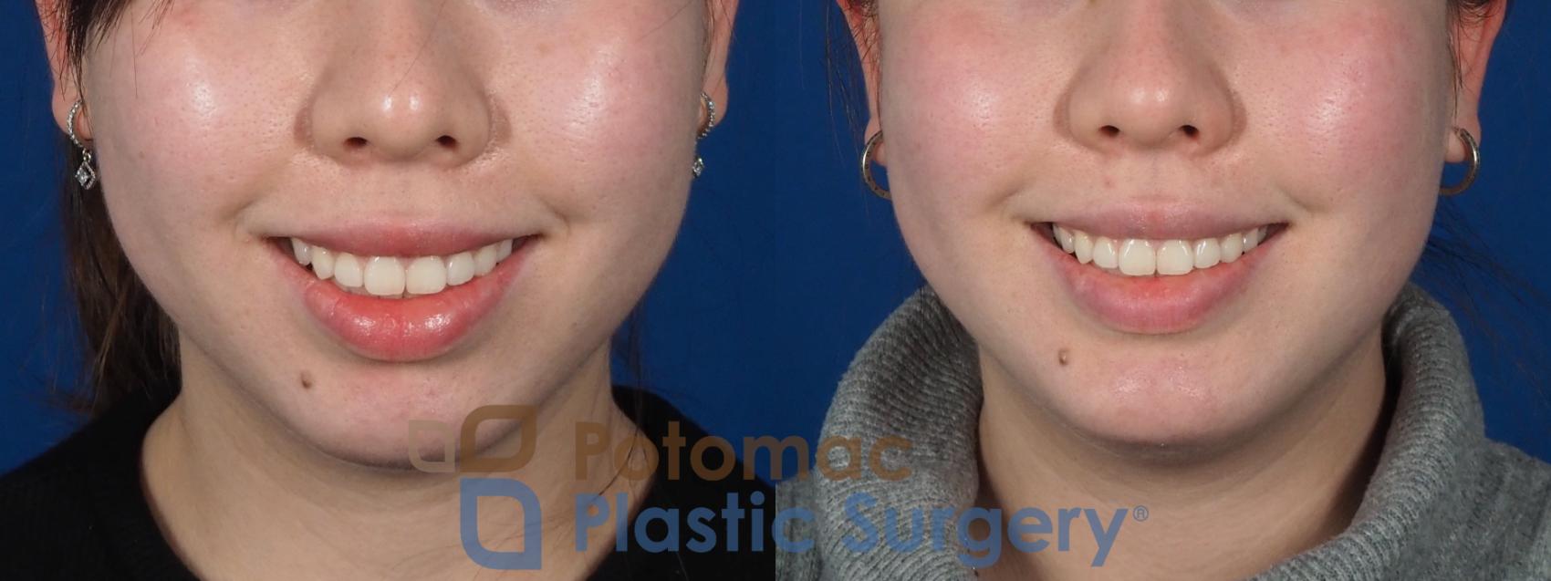 Before & After Chin Augmentation Case 280 Front - Smile View in Washington, DC