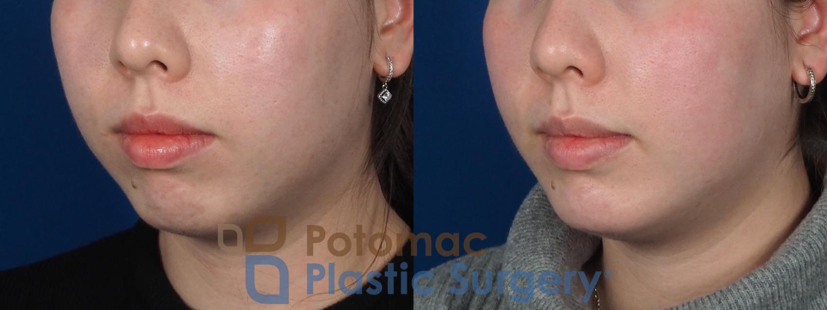 Before & After Chin Augmentation Case 280 Left Oblique View in Washington, DC