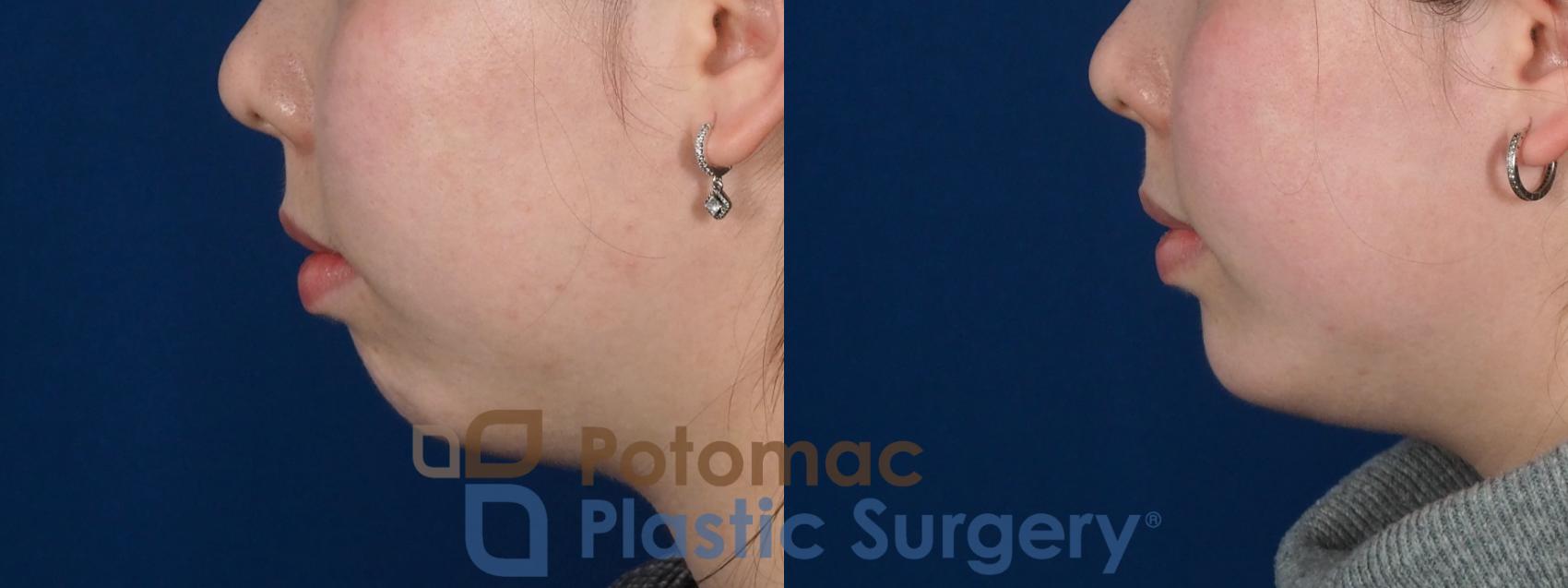 Before & After Chin Augmentation Case 280 Left Side View in Washington, DC