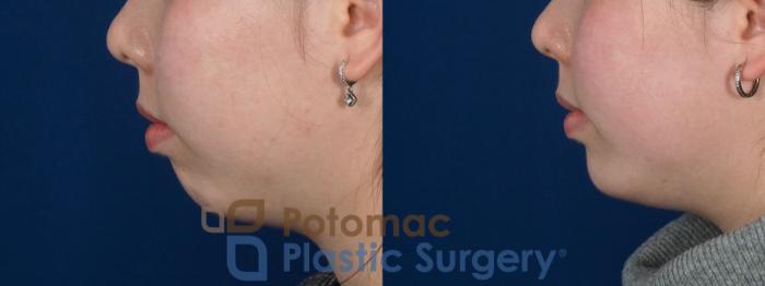 Before & After Facial Sculpting Case 280 Left Side View in Washington DC & Arlington , DC