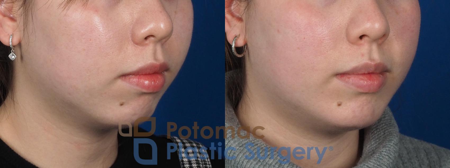 Before & After Chin Augmentation Case 280 Right Oblique View in Washington, DC