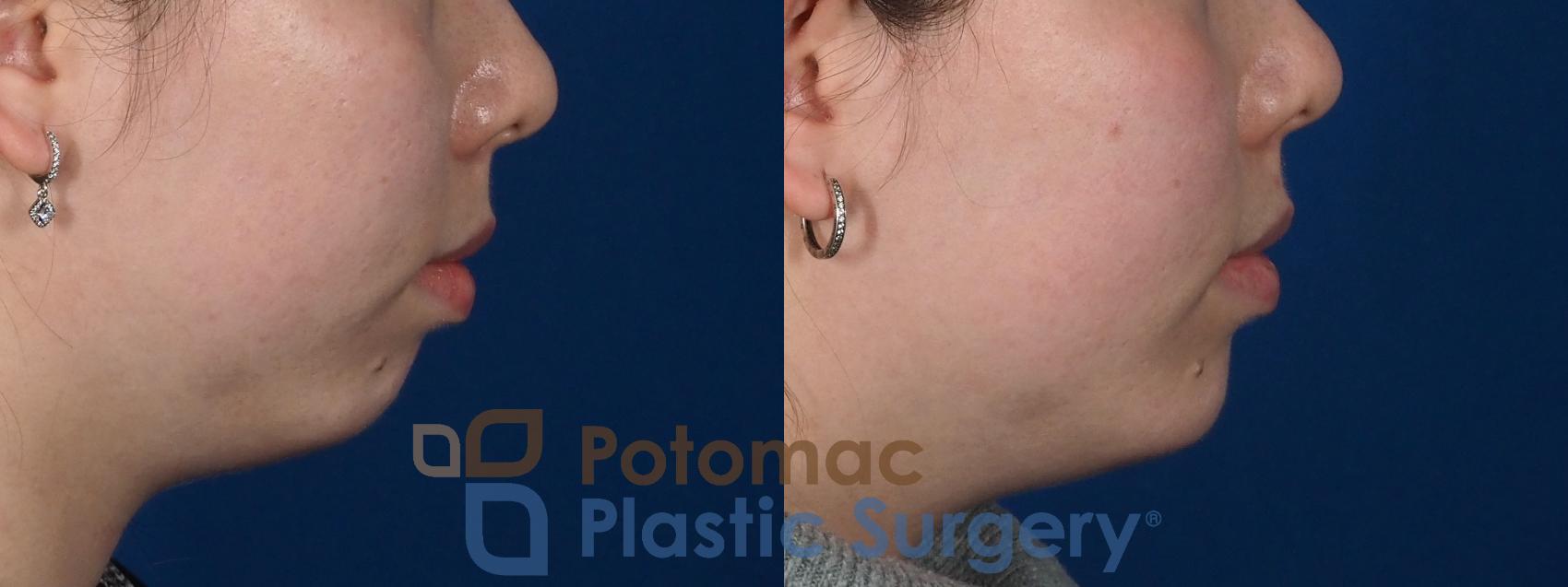 Before & After Chin Augmentation Case 280 Right Side View in Washington, DC