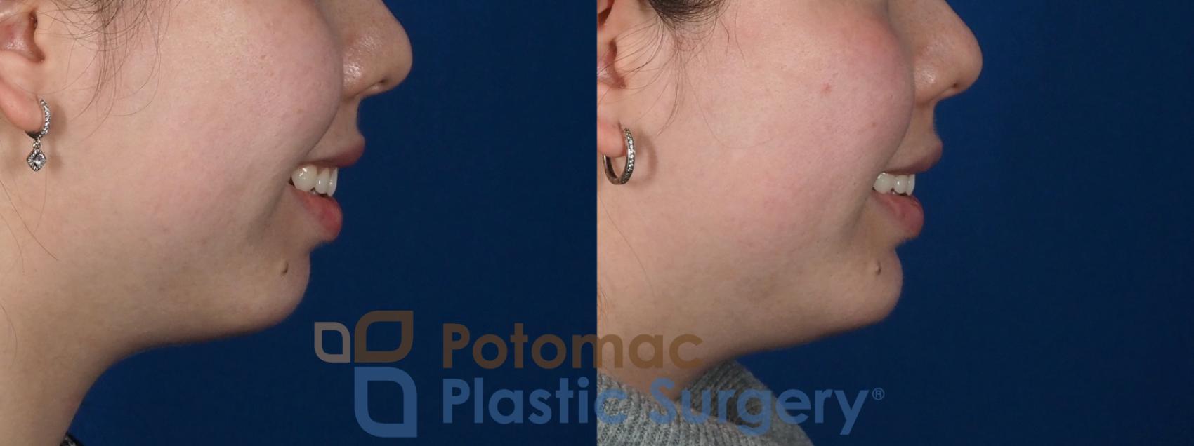 Before & After Chin Augmentation Case 280 Right Side - Smile View in Washington, DC