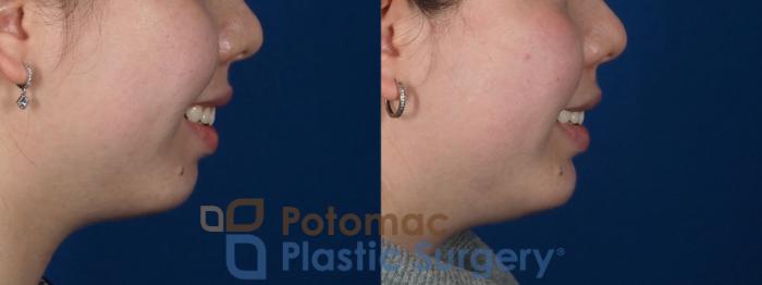 Before & After Facial Sculpting Case 280 Right Side - Smile View in Washington DC & Arlington , DC