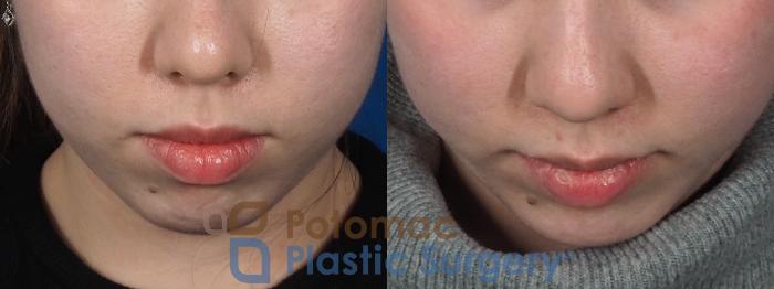 Before & After Chin Augmentation Case 280 Top View in Washington DC & Arlington , DC
