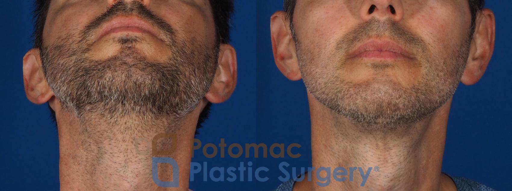 Before & After Chin Augmentation Case 292 Bottom View in Washington, DC
