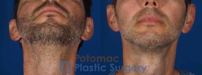 Before & After Chin Augmentation Case 292 Bottom View in Washington DC & Arlington , DC