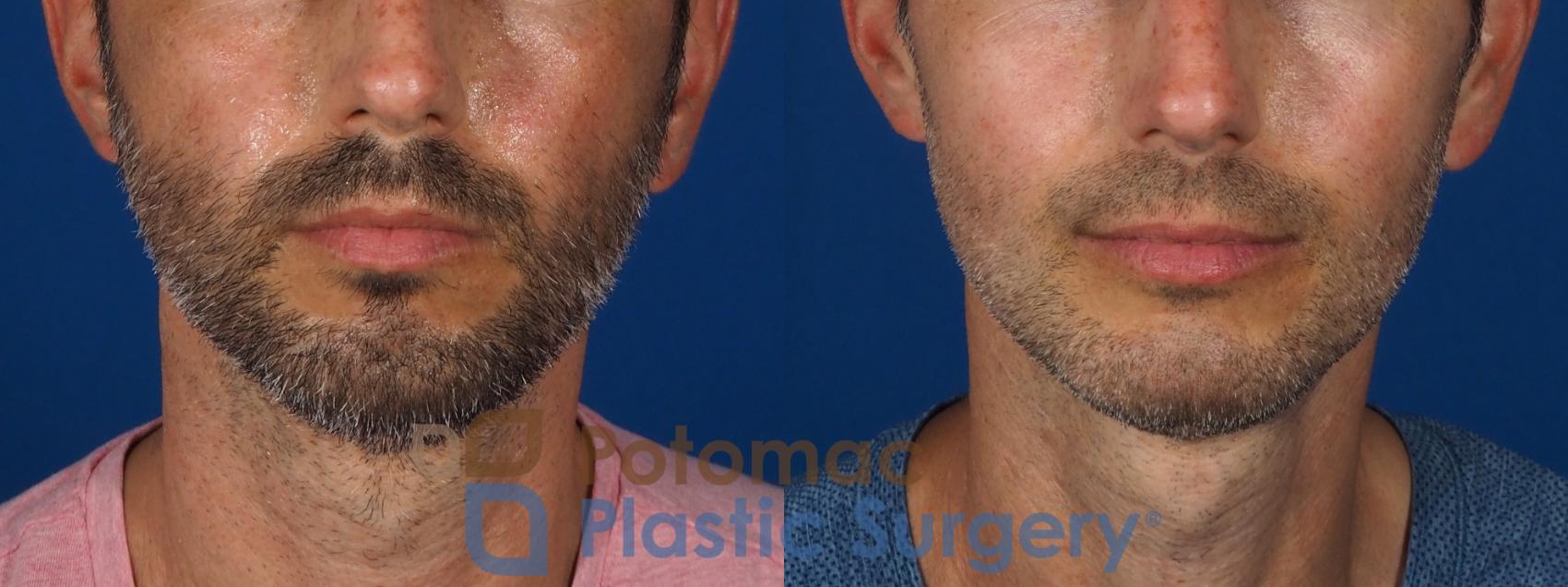 Before & After Chin Augmentation Case 292 Front View in Washington, DC