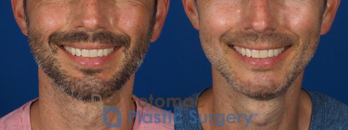 Before & After Chin Augmentation Case 292 Front - Smiling View in Washington DC & Arlington , DC