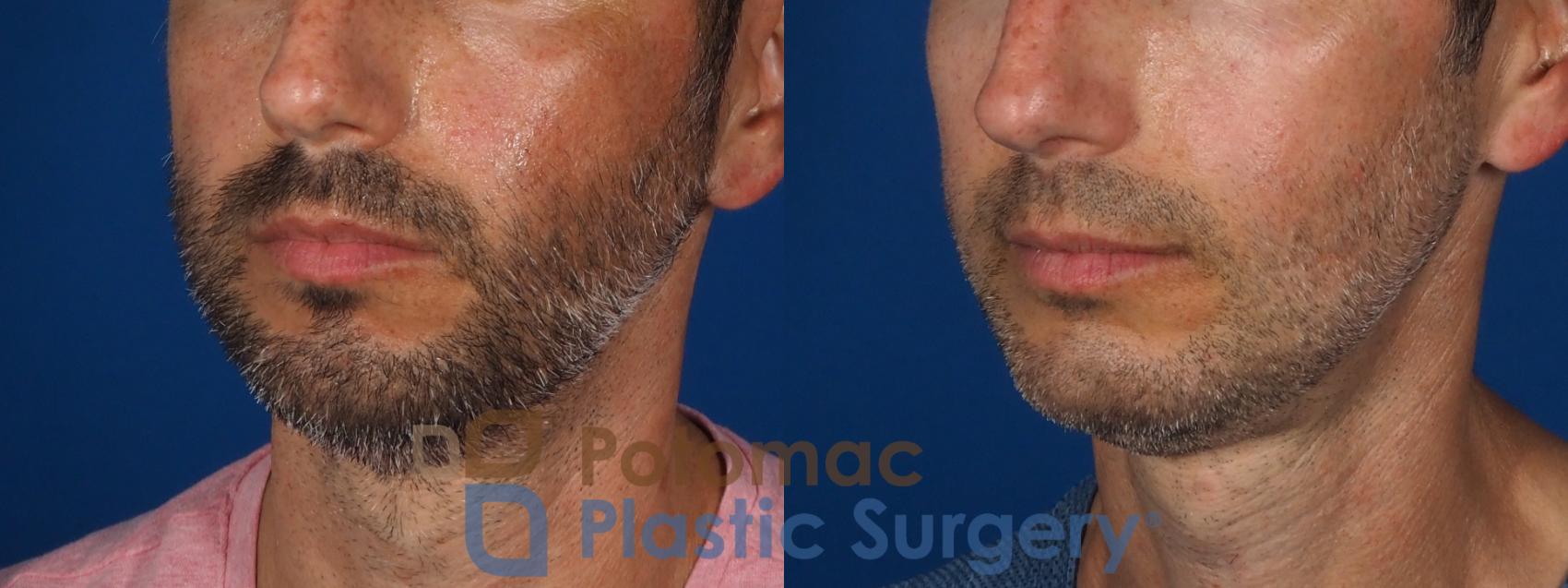 Before & After Chin Augmentation Case 292 Left Oblique View in Washington, DC