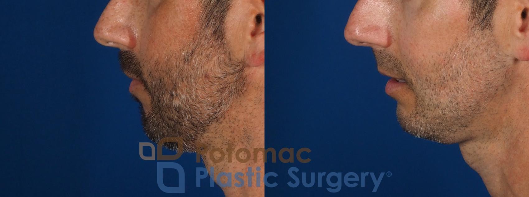 Before & After Chin Augmentation Case 292 Left Side View in Washington, DC