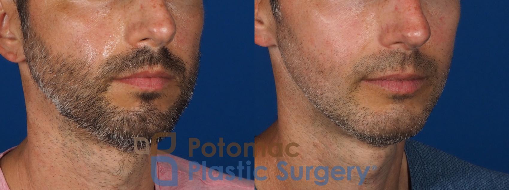 Before & After Chin Augmentation Case 292 Right Oblique View in Washington, DC