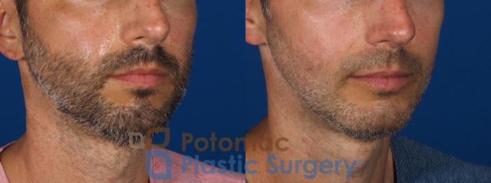 Before & After Facial Sculpting Case 292 Right Oblique View in Washington DC & Arlington , DC