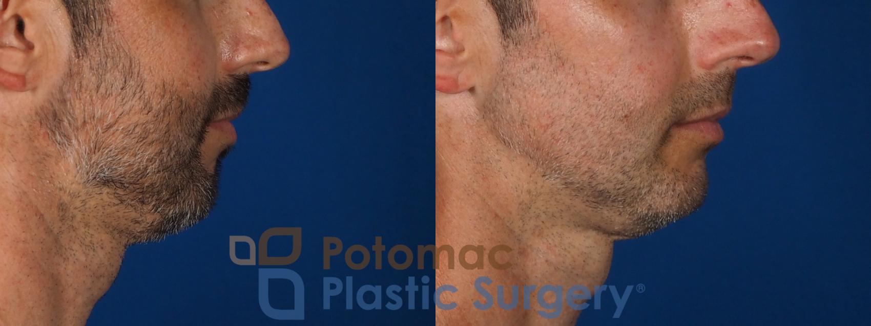 Before & After Chin Augmentation Case 292 Right Side View in Washington, DC