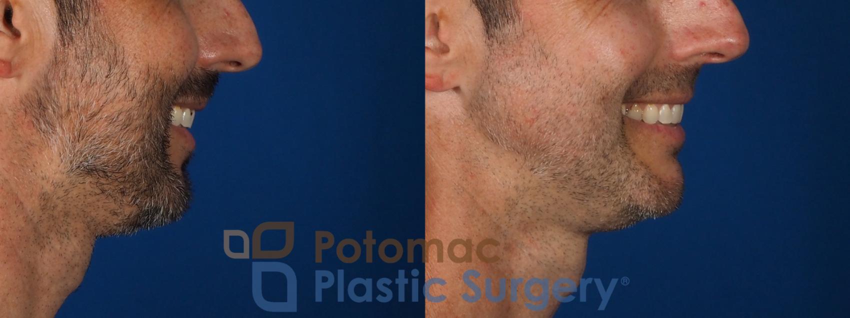 Before & After Chin Augmentation Case 292 Right Side - Smiling View in Washington, DC