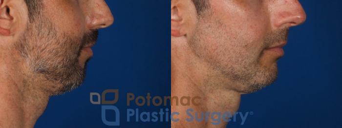 Before & After Chin Augmentation Case 292 Right Side View in Washington DC & Arlington , DC