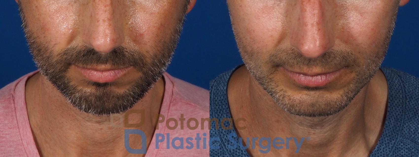 Before & After Chin Augmentation Case 292 Top View in Washington, DC