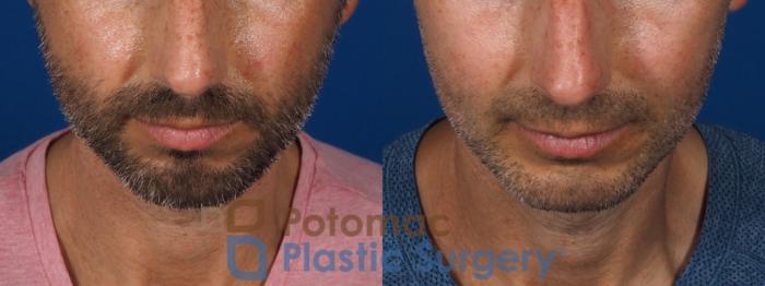 Before & After For Men Case 292 Top View in Washington DC & Arlington , DC