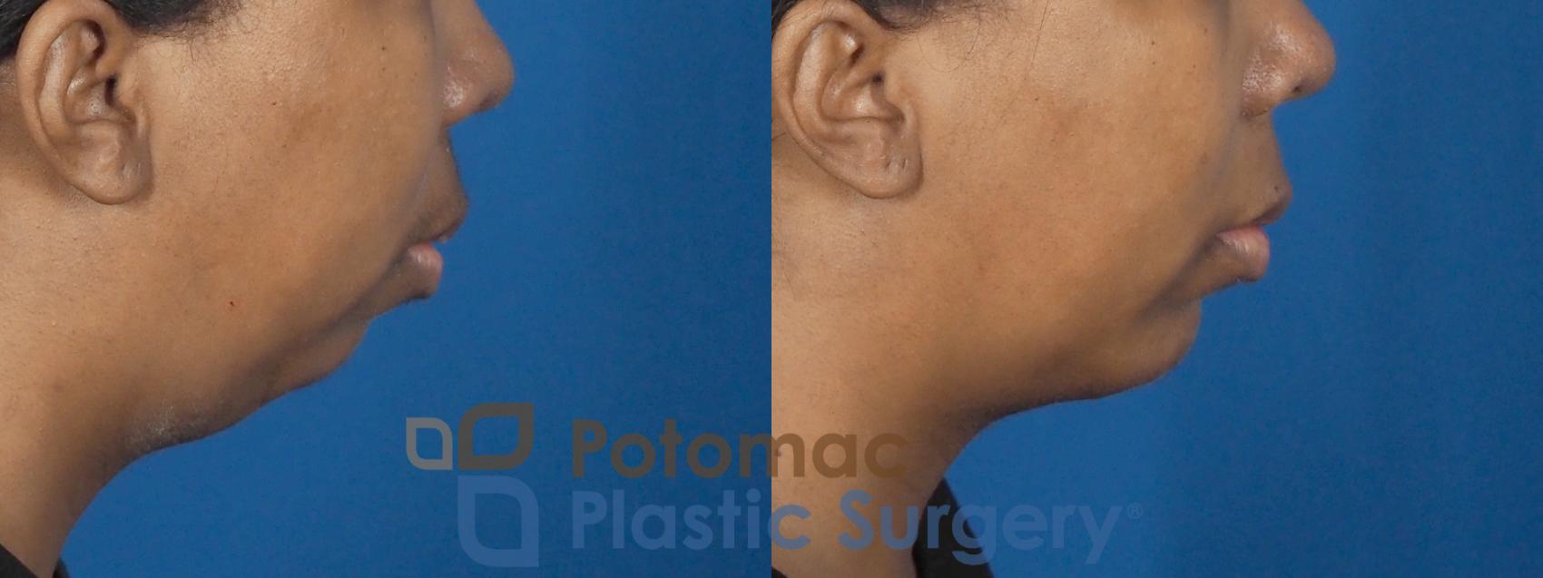 Before & After Chin Augmentation Case 338 Right Side View in Washington DC & Arlington , DC