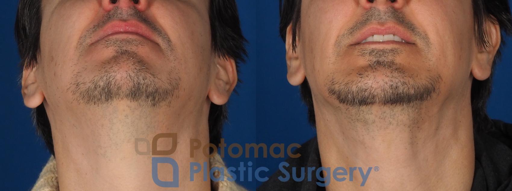 Before & After Chin Augmentation Case 341 Bottom View in Washington DC & Arlington , DC
