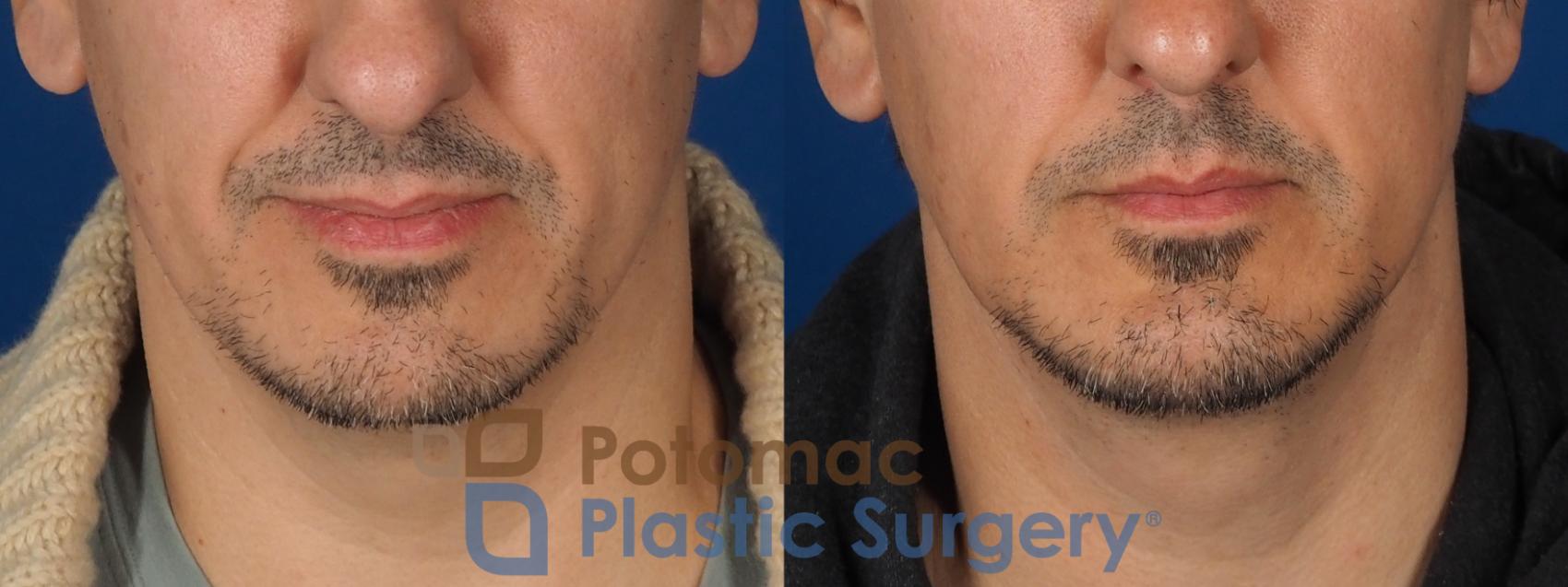 Before & After Chin Augmentation Case 341 Front View in Washington DC & Arlington , DC