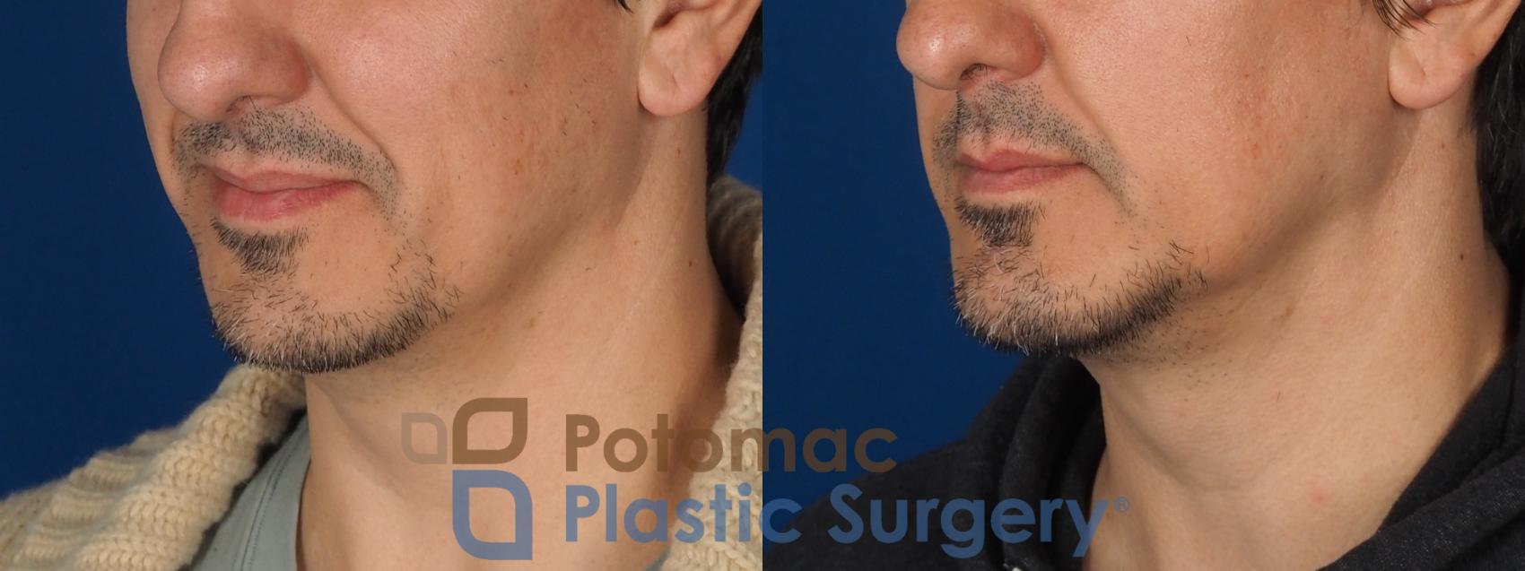Before & After Chin Augmentation Case 341 Left Oblique View in Washington DC & Arlington , DC