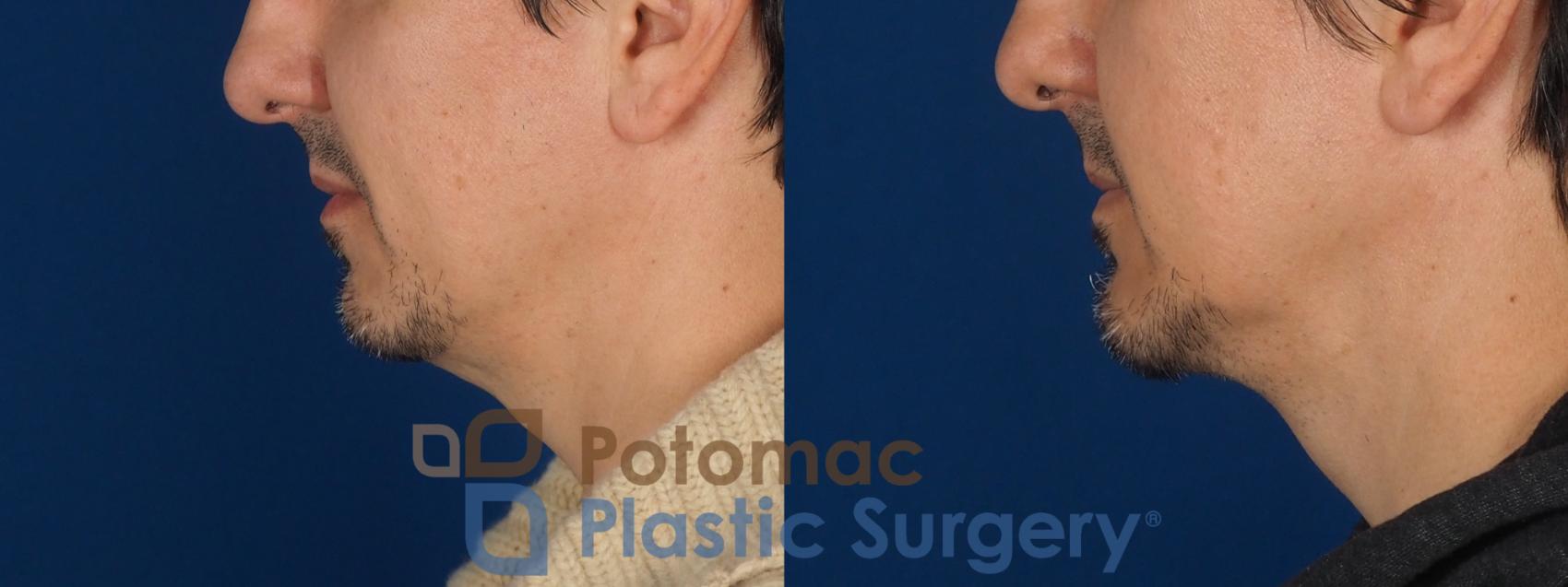 Before & After Chin Augmentation Case 341 Left Side View in Washington DC & Arlington , DC
