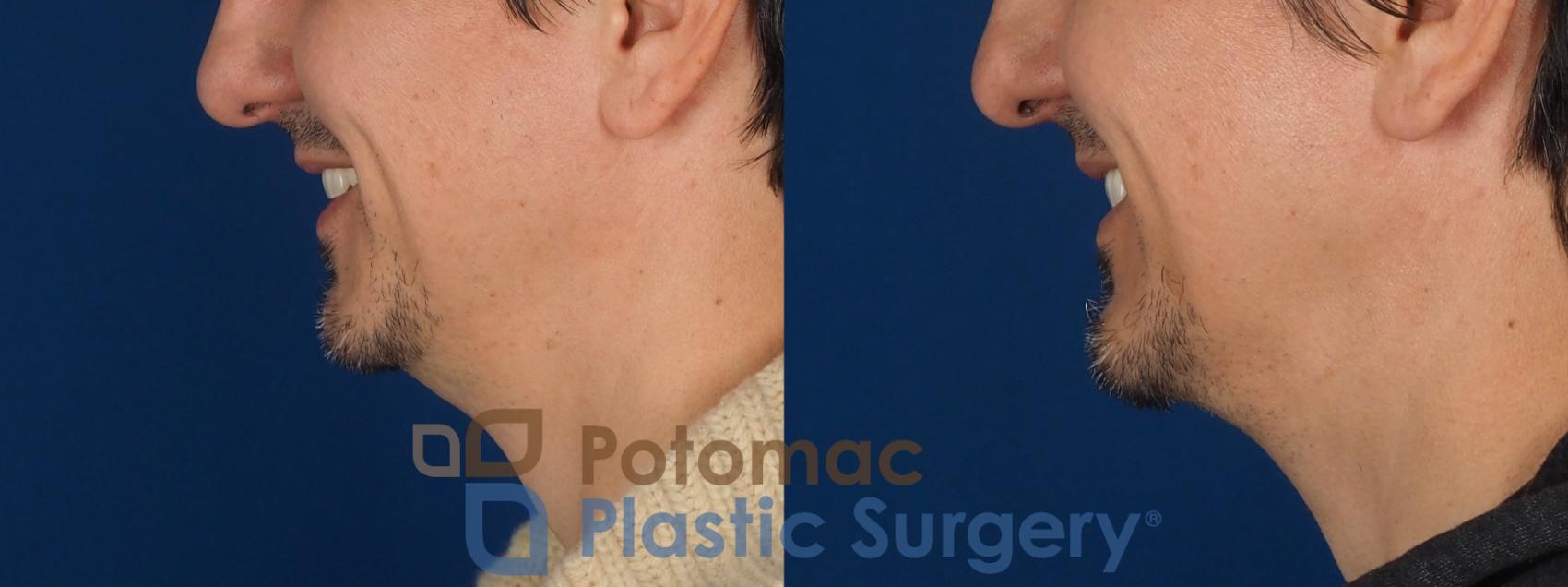 Before & After Chin Augmentation Case 341 Left - Smiling View in Washington DC & Arlington , DC