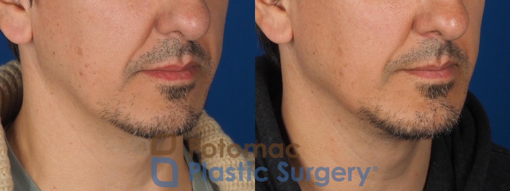 Before & After Chin Augmentation Case 341 Right Oblique View in Washington DC & Arlington , DC
