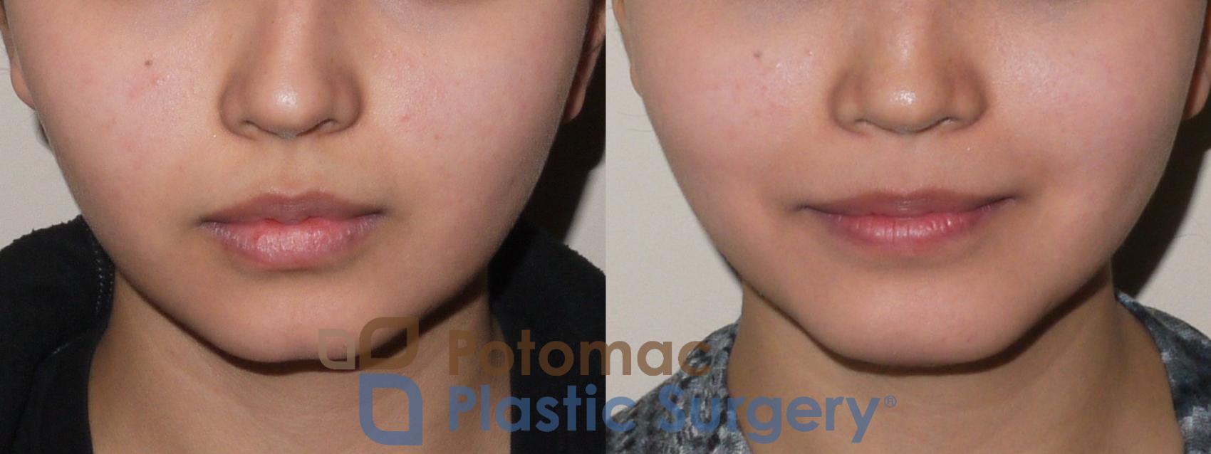 Before & After Chin Augmentation Case 49 Front View in Washington, DC