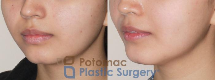 Before & After Rhinoplasty - Cosmetic Case 49 Left Oblique View in Washington DC & Arlington , DC