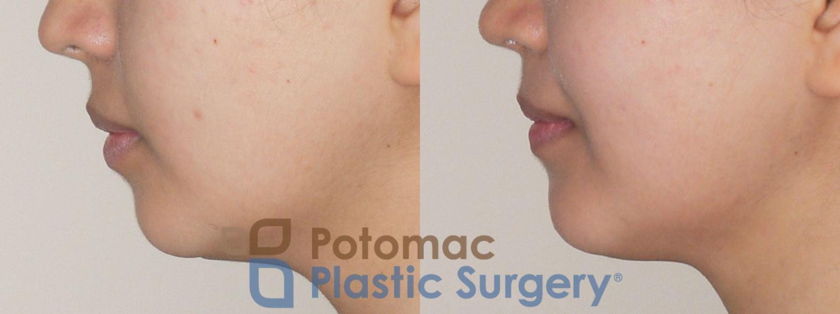 Before & After Chin Augmentation Case 49 Left Side View in Washington, DC