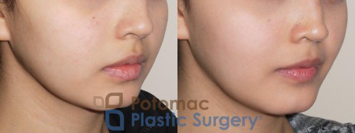 Before & After Chin Augmentation Case 49 Right Oblique View in Washington DC & Arlington , DC