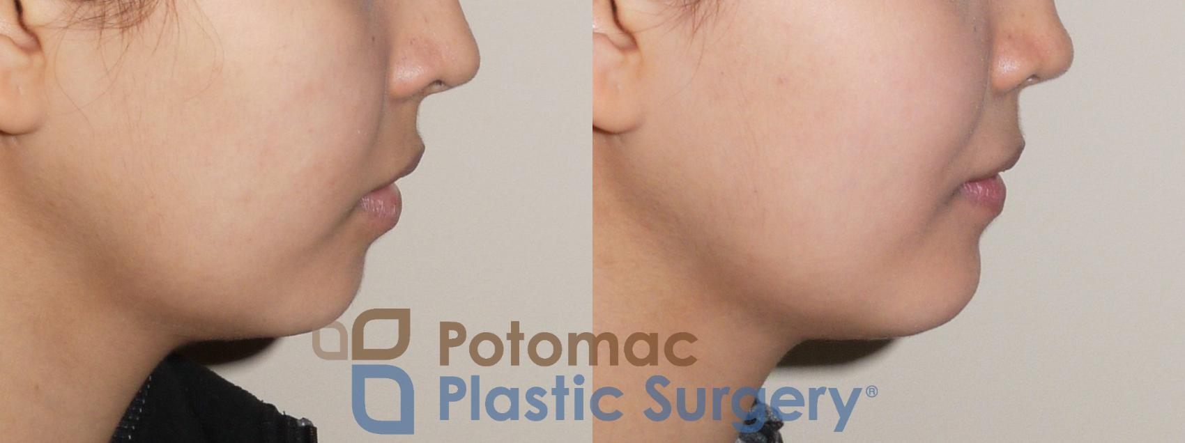 Before & After Chin Augmentation Case 49 Right Side View in Washington, DC